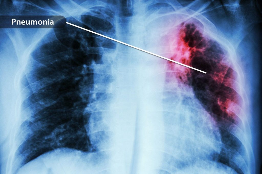Long COVID Lung Damage