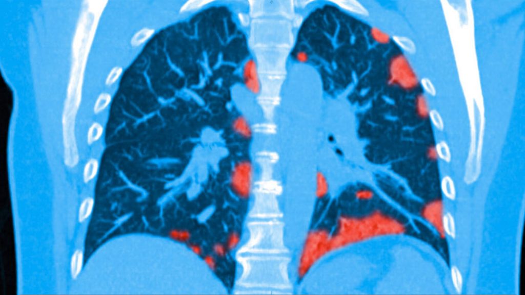 Long COVID lung damage