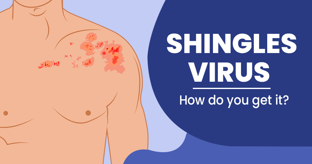Is Shingles Contagious