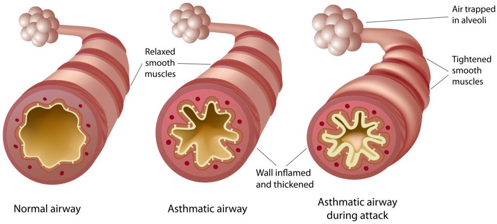 What is Asthma