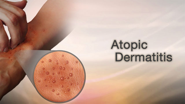 Atopic Dermatitis Treatment Symptoms